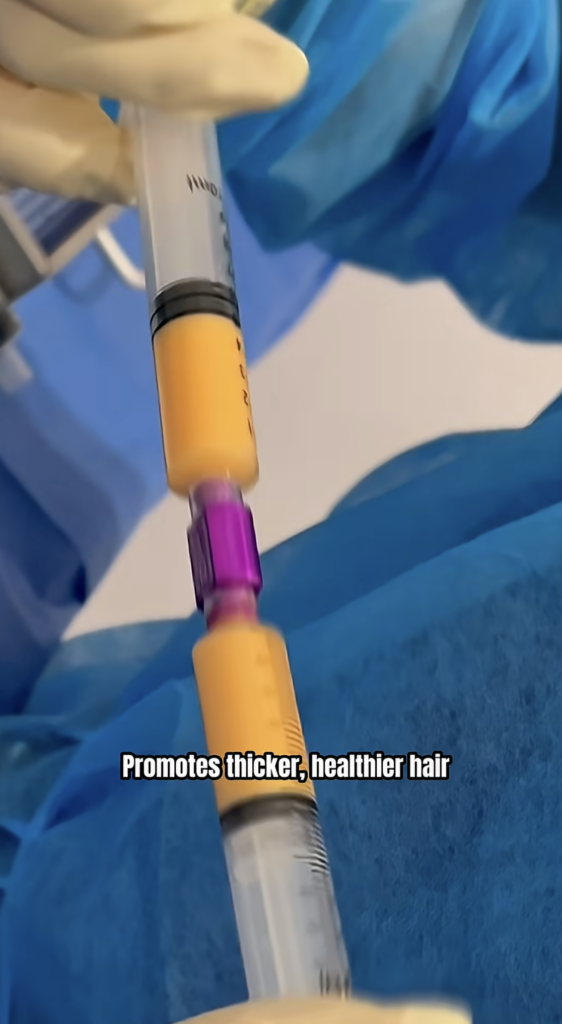 Close-up view of syringes and gloved hands positioned over a patient’s scalp during a procedure.