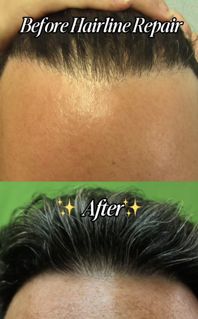 Split before-and-after image showing the patient's hairline before repair and his hair brushed back afterward.