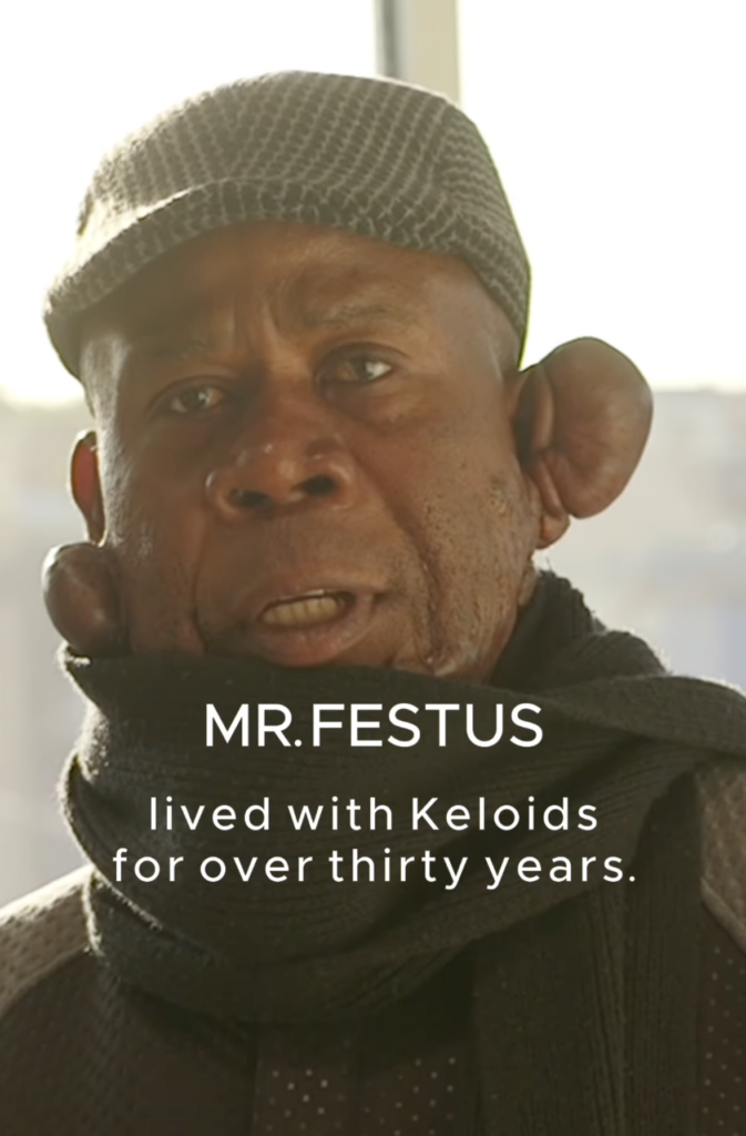 Close-up of Festus wearing a patterned cap and dark scarf with growths visible near both ears.