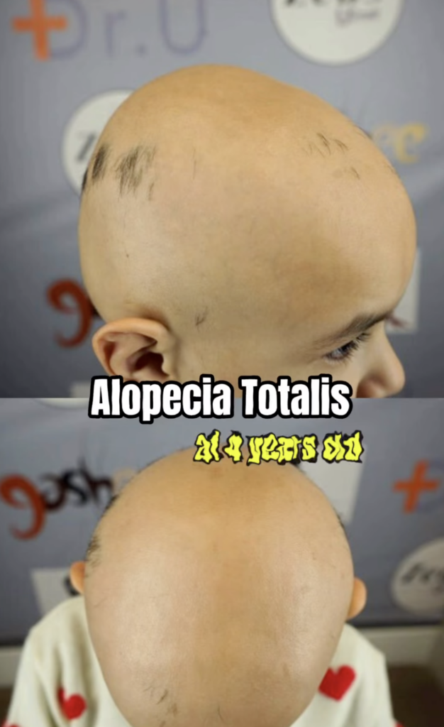 Two close views of a young child's scalp with sparse patches of hair and text reading Alopecia Totalis at 4 years old.