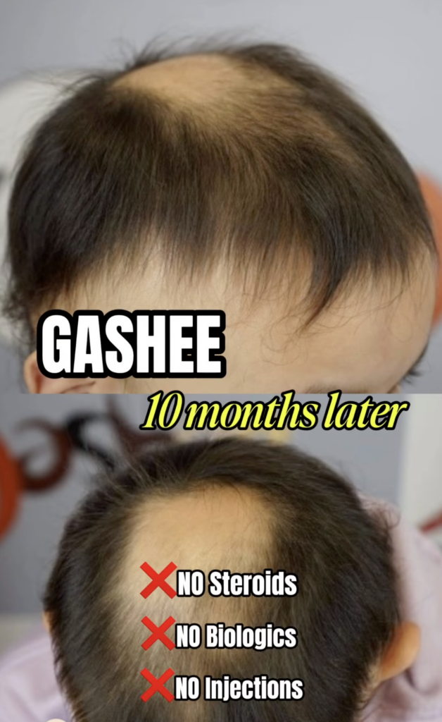 Two later views of a young child's scalp with more visible hair and text reading GASHEE 10 months later, no steroids, no biologics, no injections.