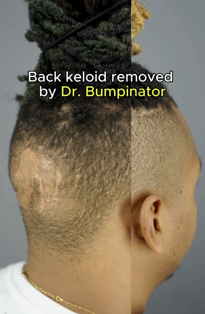Split view of the back and side of a man’s scalp with a scarred area and text about back keloid removal by Dr. Bumpinator.