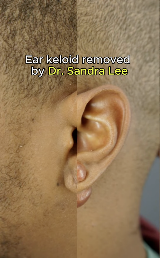 Split close-up of a man’s ear and surrounding skin with text about ear keloid removal by Dr. Sandra Lee.