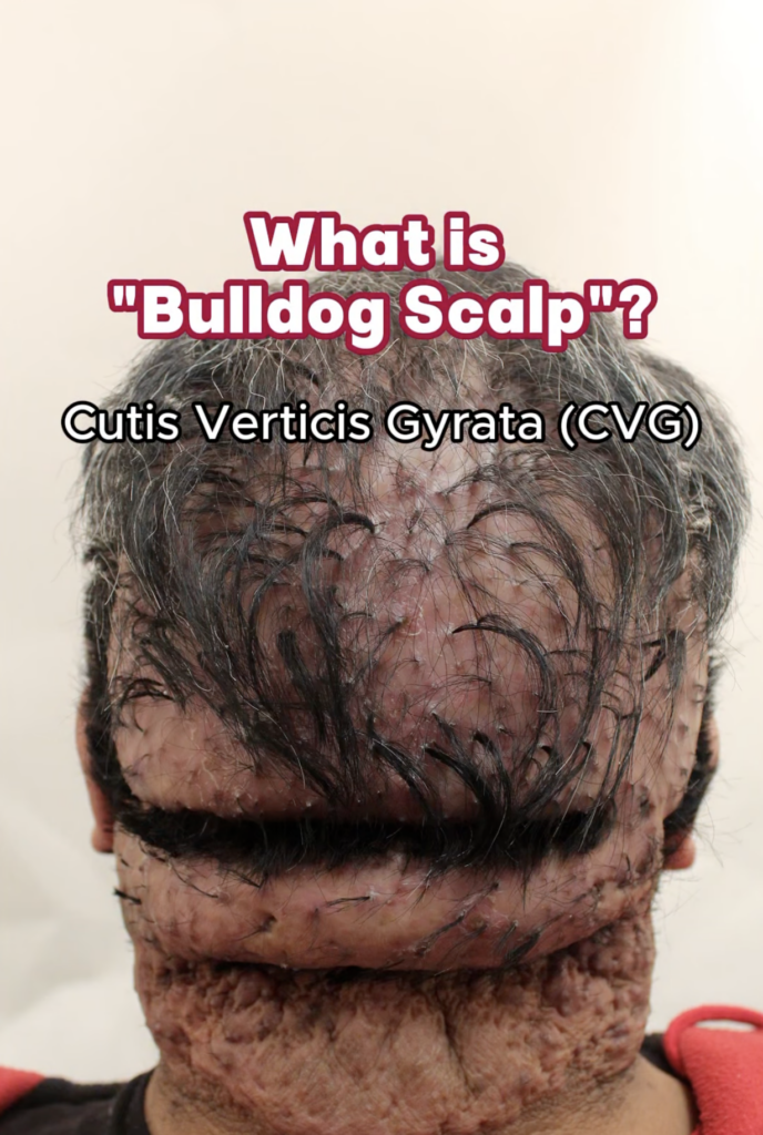 Close-up of a person's scalp with deep folds, ridges, sparse hair, and overlaid text identifying Cutis Verticis Gyrata.