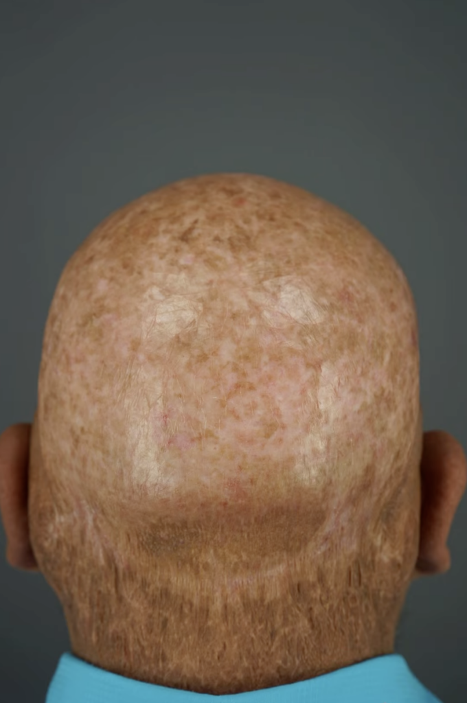 Rear view of a closely shaved scalp showing areas of varied pigmentation against a dark gray background.