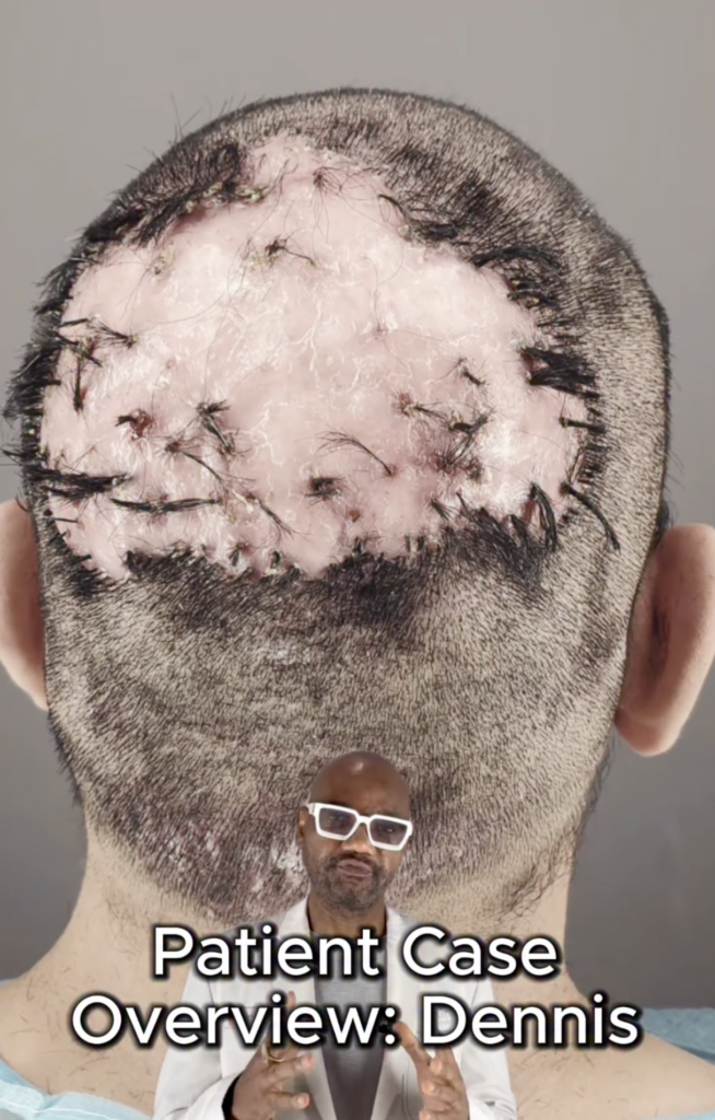 Rear view of a closely shaved head with a large pink scalp area containing sutures and short hair around the perimeter.
