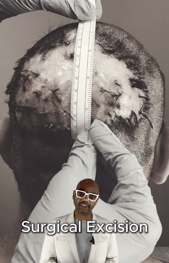 Gloved hands hold a ruler vertically over a large sutured area on the back of a closely shaved scalp.