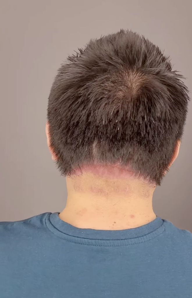 Rear view of Arturo’s head with dark hair and a pink area visible along the lower hairline.