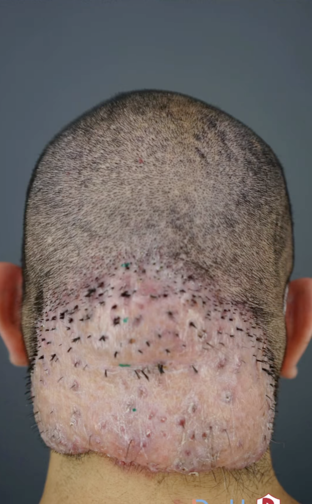 Rear view of Arturo’s shaved scalp with a broad treated area across the lower back of the head.