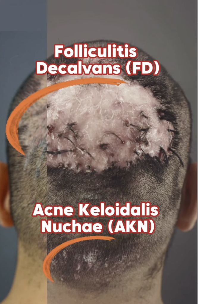 Rear view of a shaved scalp with FD and AKN text labels and orange arrows pointing to scalp areas.