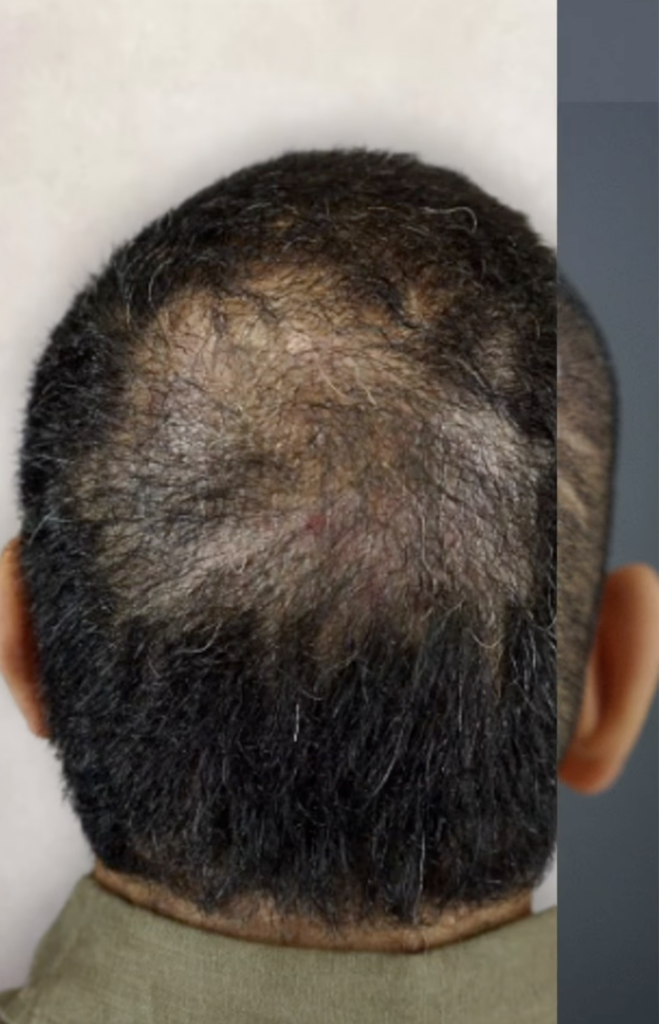 Rear view of a man’s head with a broad area of reduced hair density across the upper back of the scalp.