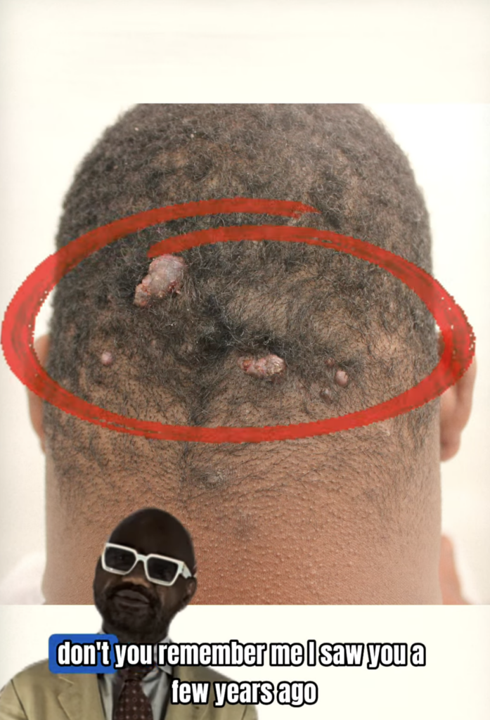 Rear view of a scalp with several raised bumps highlighted by a red circle.