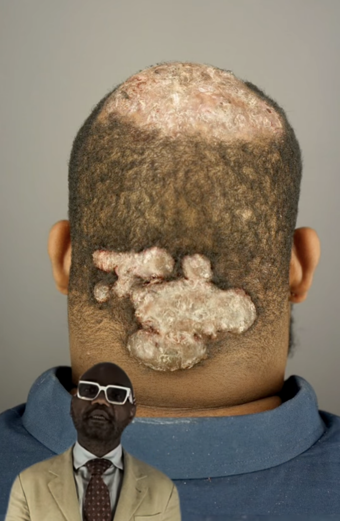 Rear view of a scalp with multiple large raised lesions across the crown and back of the head.