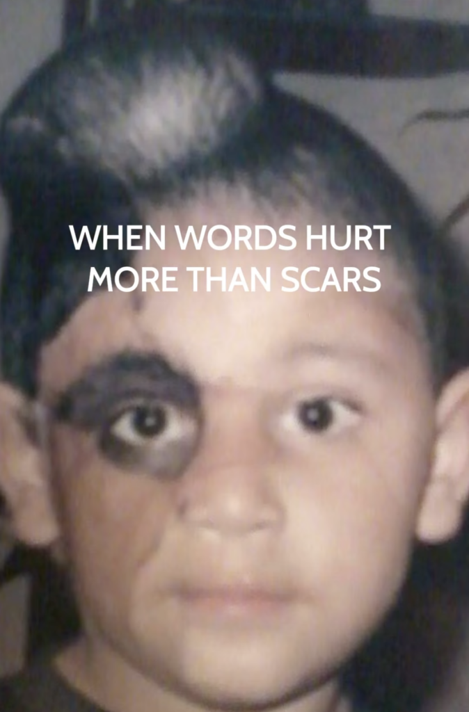 Childhood portrait of Alejandro with a dark birthmark around one eye and extending into the hairline.
