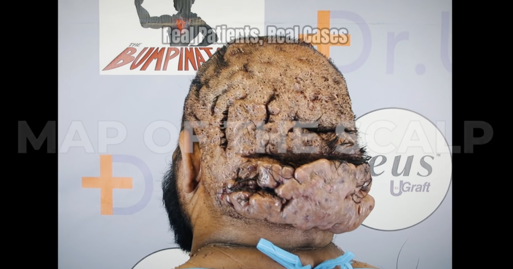 Rear view of a man’s scalp and neck showing extensive raised lesions, thick scarring, and deep folds across the scalp.