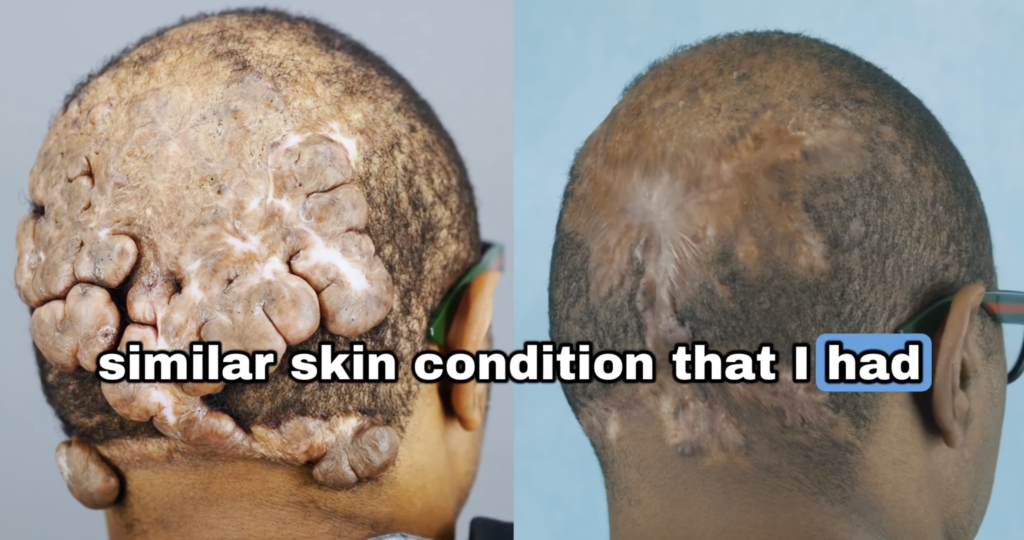  Side-by-side rear scalp views showing large raised lesions in one image and flatter scarring with hair coverage in a later healing-stage image.