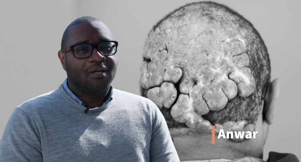 A man wearing glasses and a gray sweater appears beside a black-and-white rear scalp image with multiple large raised lesions; the on-screen label reads Anwar.