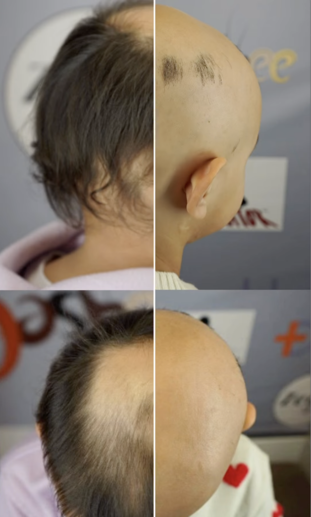 Four close-up views of a child’s scalp showing different amounts and patterns of visible scalp hair.