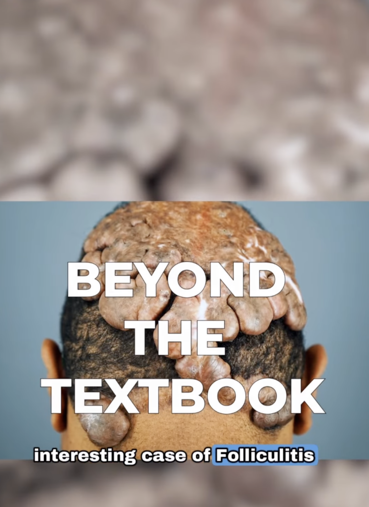 Rear view of a man’s scalp with multiple large raised lesions across the top and back of the head, overlaid with the words Beyond the Textbook.