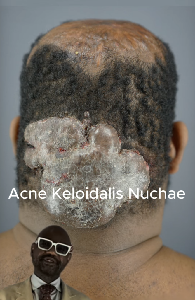 Rear view of a man’s head and neck with several large raised lesions and areas of hair loss; the image includes the words Acne Keloidalis Nuchae.