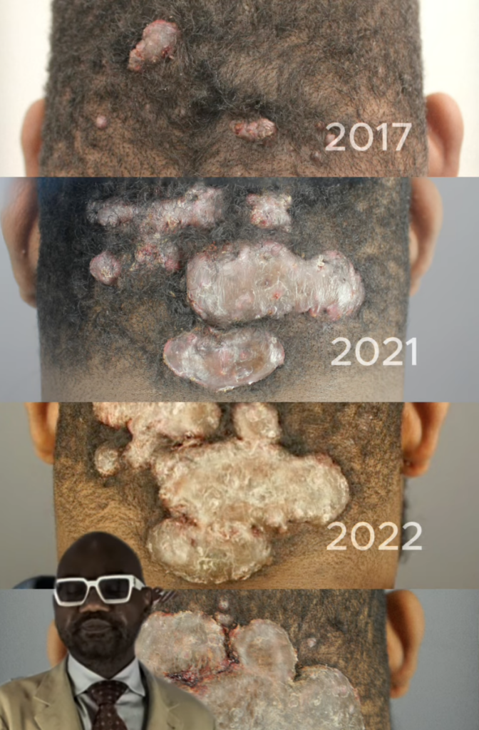  Four stacked rear views of a man’s scalp showing raised bumps of different sizes, with 2017, 2021, and 2022 labels on three images.