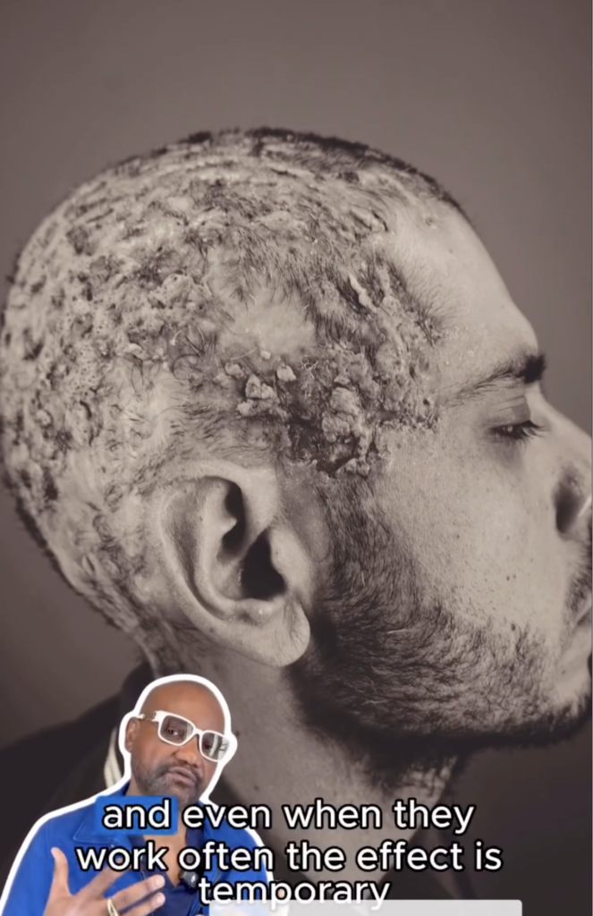 Side view of Kevin’s scalp with widespread raised, crusted areas and short hair, with Dr. Umar speaking in an inset.