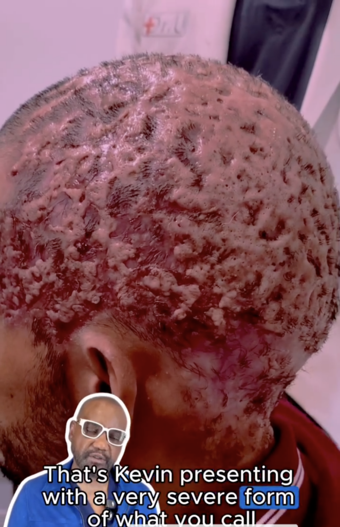 Close rear-side view of Kevin’s scalp with widespread raised, crusted and reddened areas, with Dr. Umar speaking in an inset.