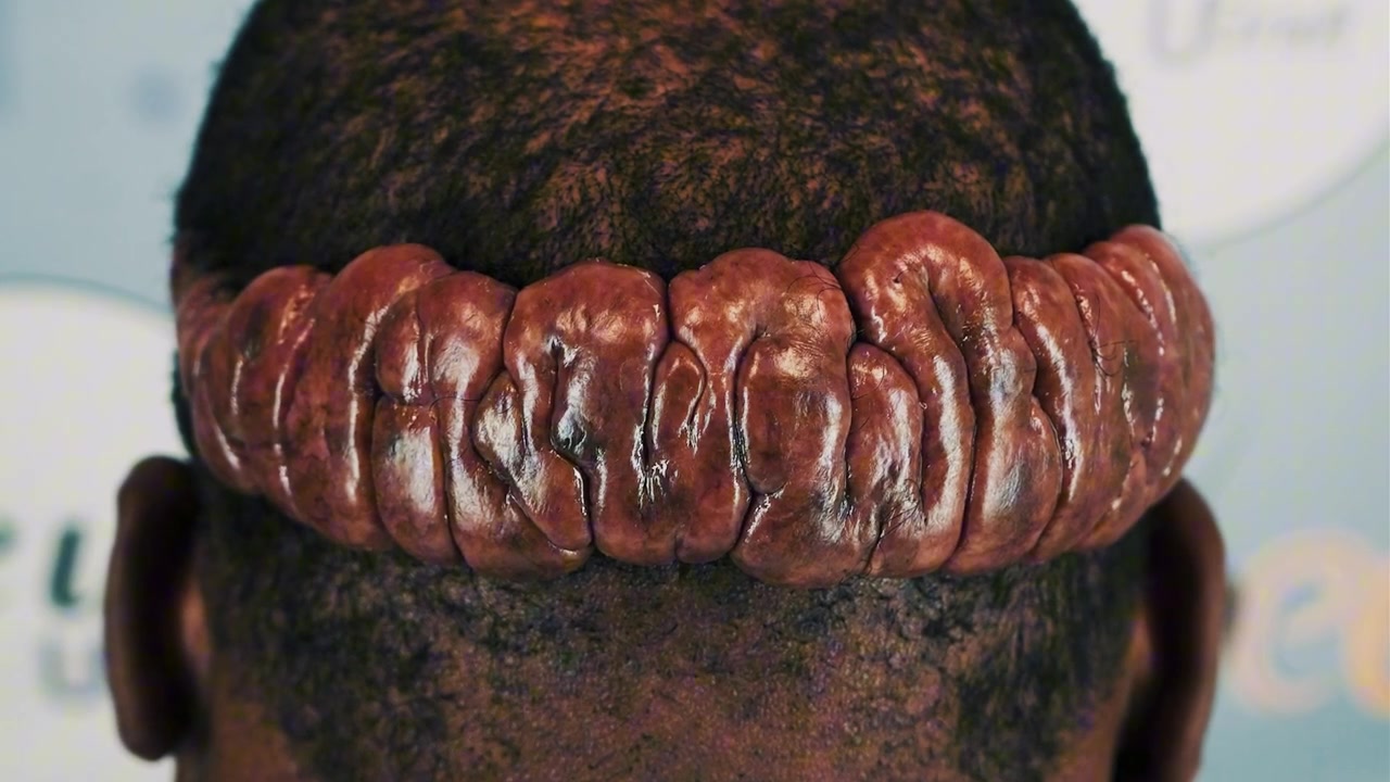 Severe Keloid Removal: Why Surgeons Refuse Treatment