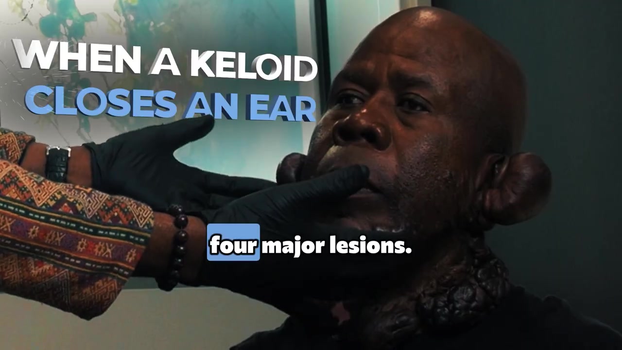 Ear Keloid Deforming the Ear: Festus’ First Exam (Festus Chapter 2)