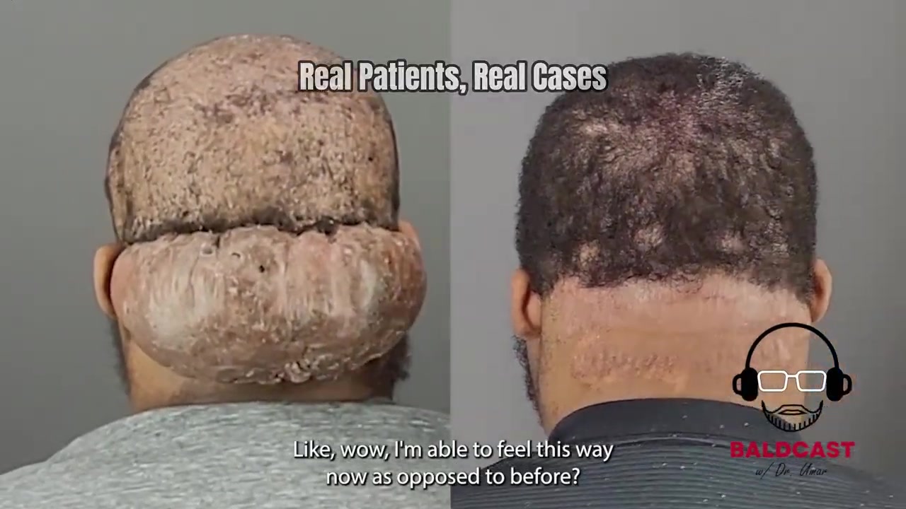 Comfort Returns, A Cicatricial Folliculitis Story | Adrian’s Journey