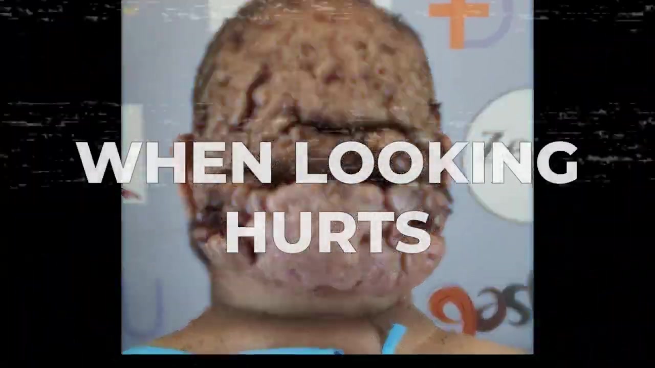 When Looking Became Painful John’s Story of Living with Scalp Disease