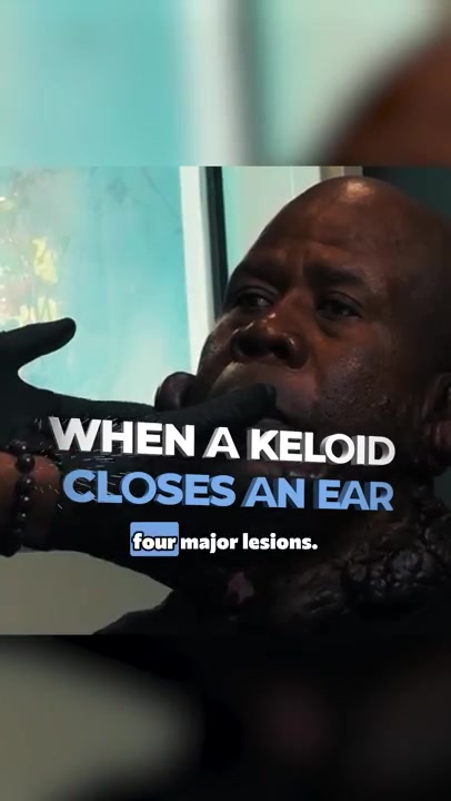 Ear Keloid Pushing the Ear Closed (Festus | Chapter 1)