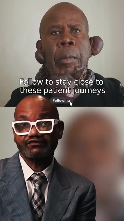 Keloid Recurrence After Surgery: Four Failures | Festus (Chapter 1)- Dr.Umar