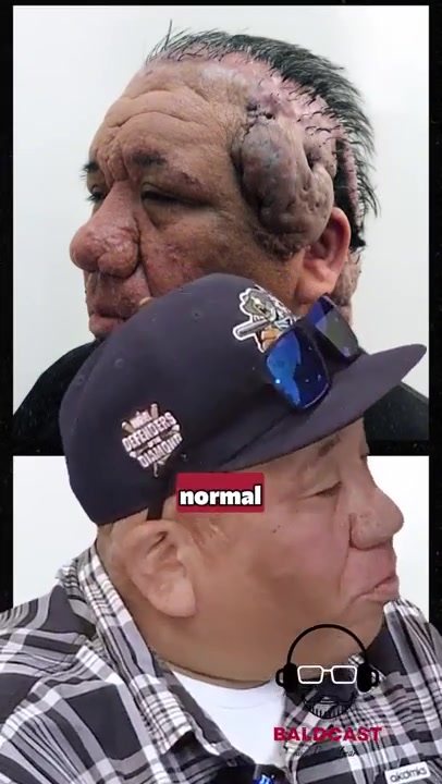 How Folliculitis Tried To Defeat Him. The Fight Robert Won | Dr Umar