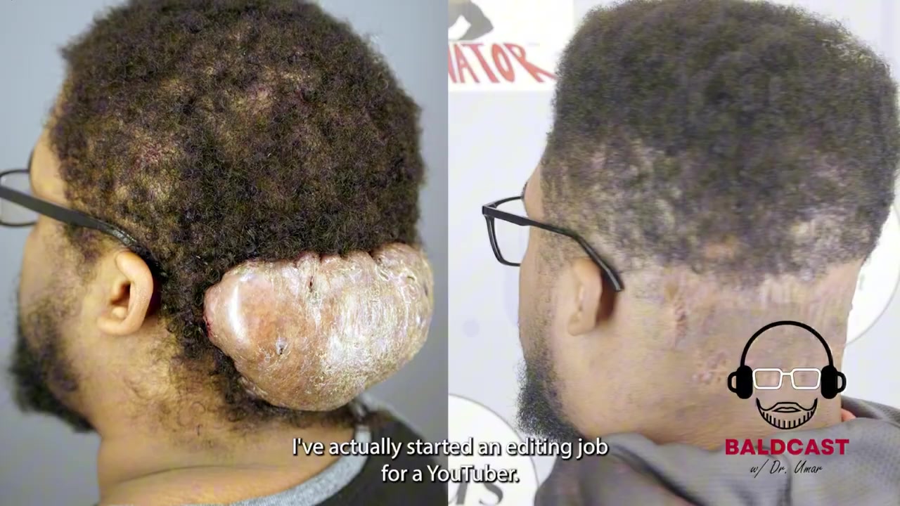 The Morning After Acne Keloidalis Nuchae Surgery | Adrian's Story