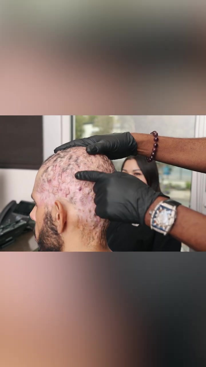 Ep 4 Ch 8 Pt 2: What Treatments Are Available for Frontal Fibrosing Alopecia (FFA)?
