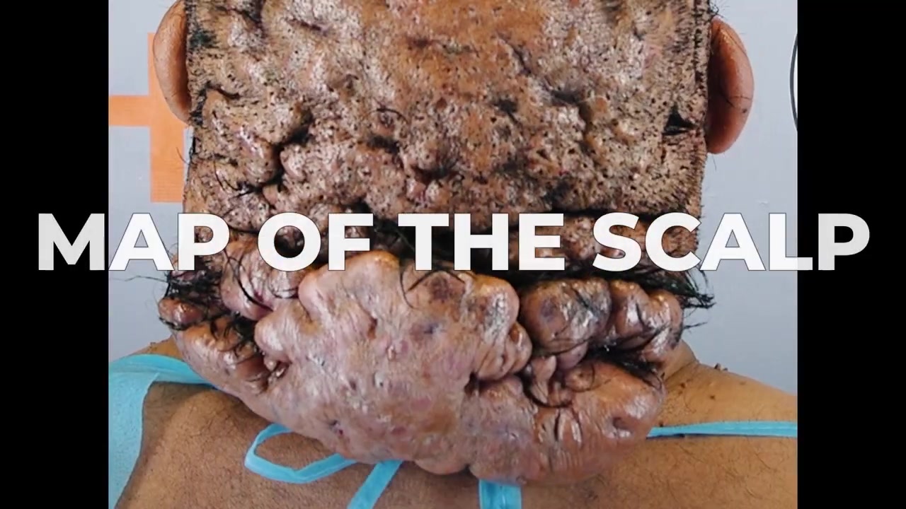 Map of The Scalp: A Deep Look Into His Painful Bumps and Scalp Folds | Dr. Umar