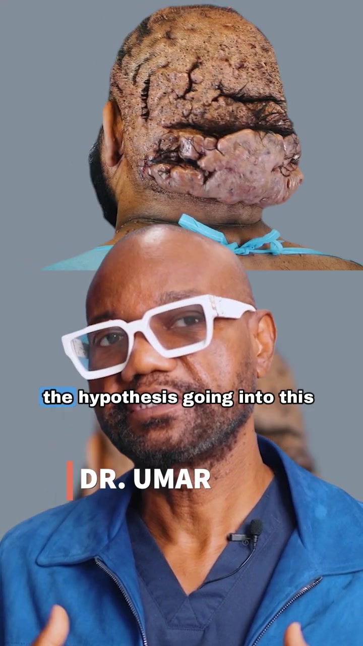 When Acne Keloidalis Nuchae Meets Dissecting Cellulitis | Part 2