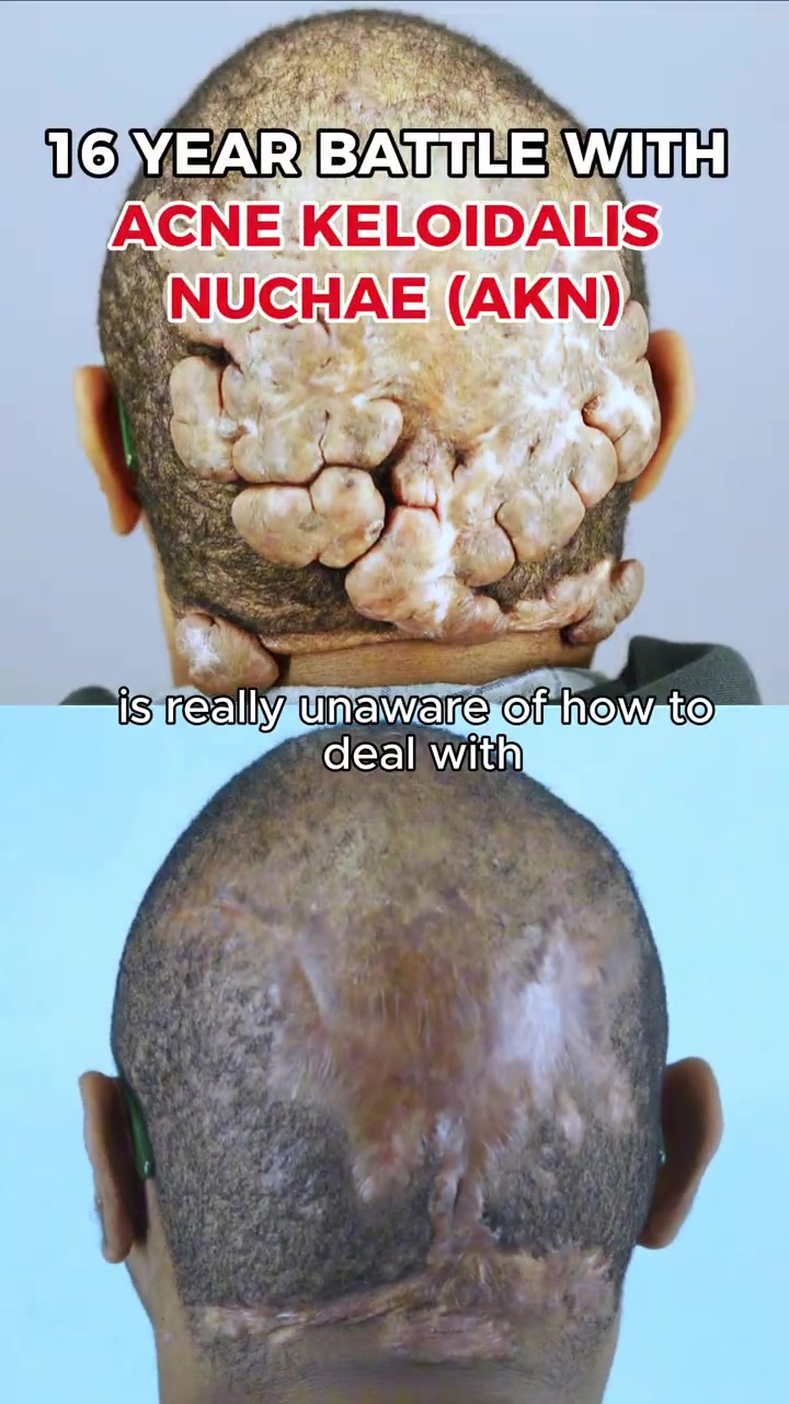 16 year battle with acne keloidalis nuchae