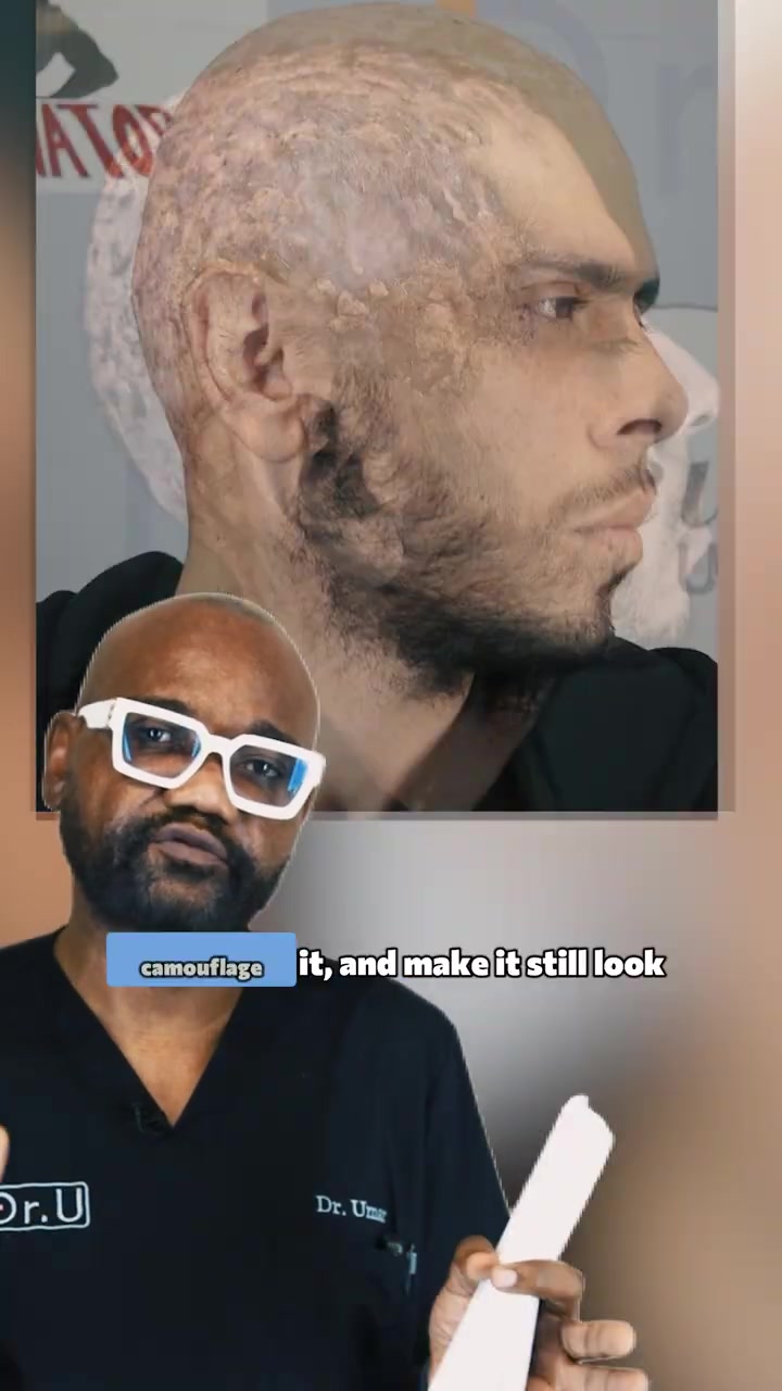 Why I Brought His Hairline Forward With Scalp Micropigmentation - SMP