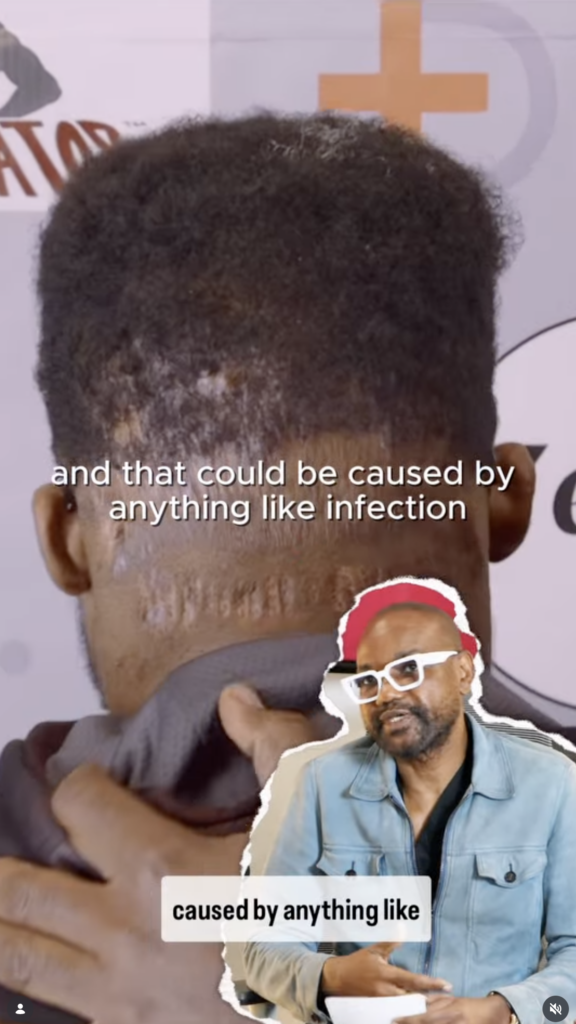Rear view of a man’s head showing patchy hair loss and visible scalp changes, with Dr. Sanusi Umar speaking in a cutout at the lower right.