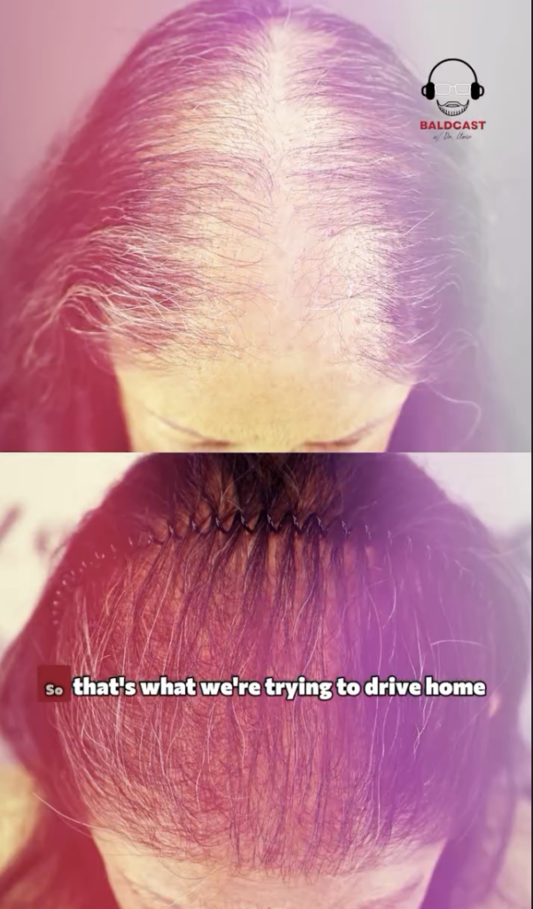 Two stacked views of a woman's scalp and hair, with Dr. Umar shown in a small inset and text across the lower image.