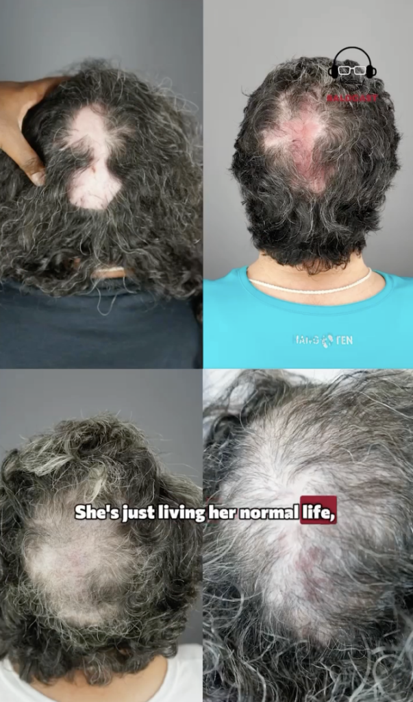 Four views of the back and top of Maria's scalp showing areas of visible scalp among gray curly hair.