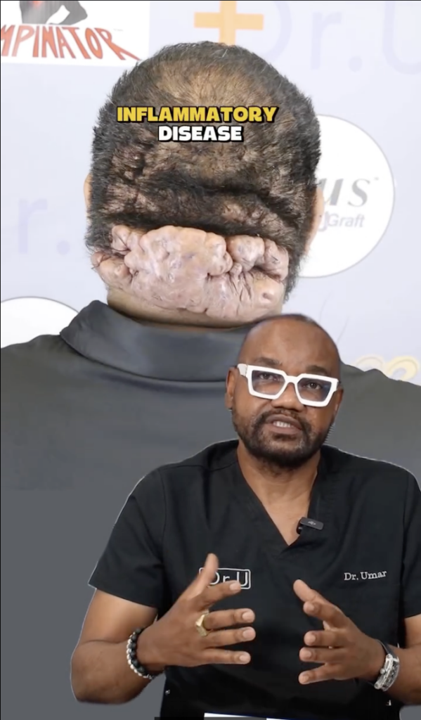 Back of a patient’s scalp and neck with extensive raised lesions, with Dr. Sanusi Umar speaking in the foreground and the words “inflammatory disease.”