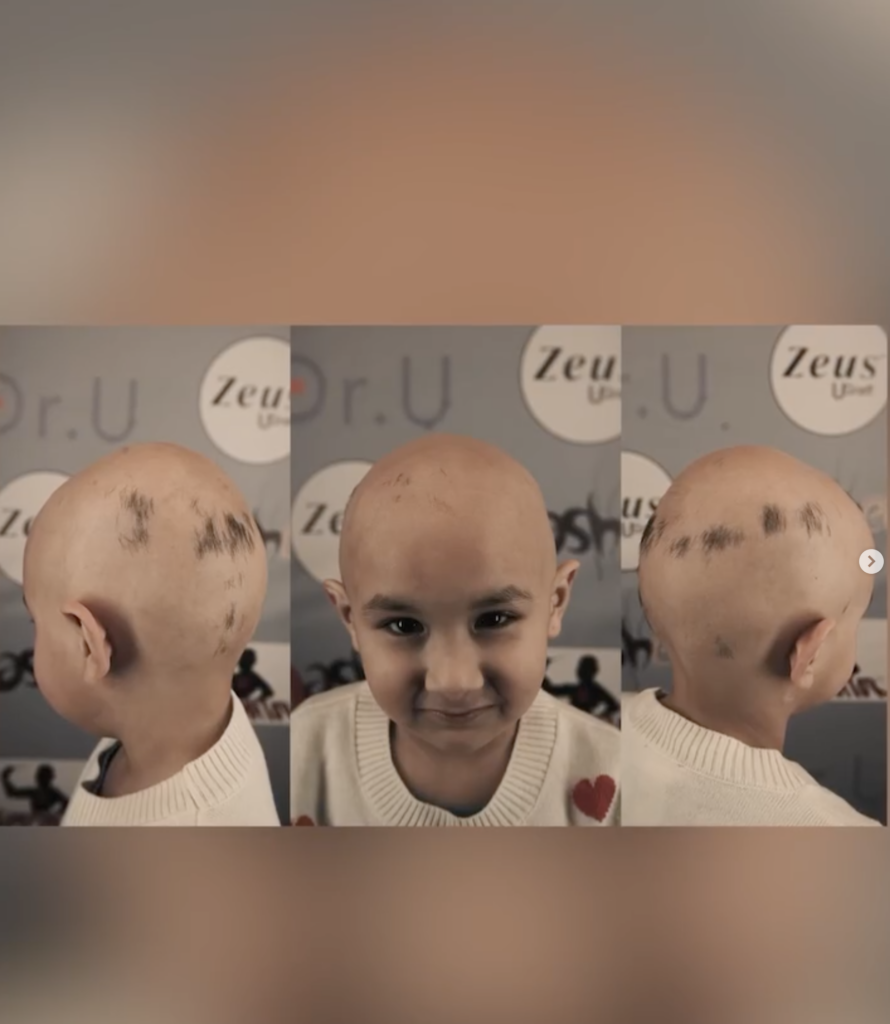 Three-view collage of Mia showing a bald scalp with small areas of hair, photographed from the left, front, and right.