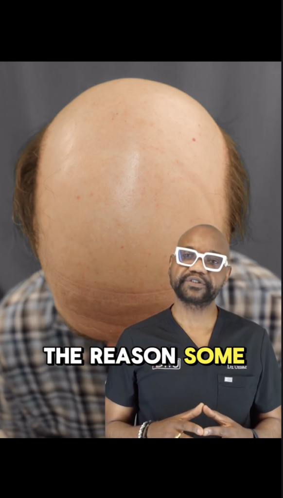 Front view of a person with extensive scalp hair loss, with Dr. Sanusi Umar speaking in the foreground.