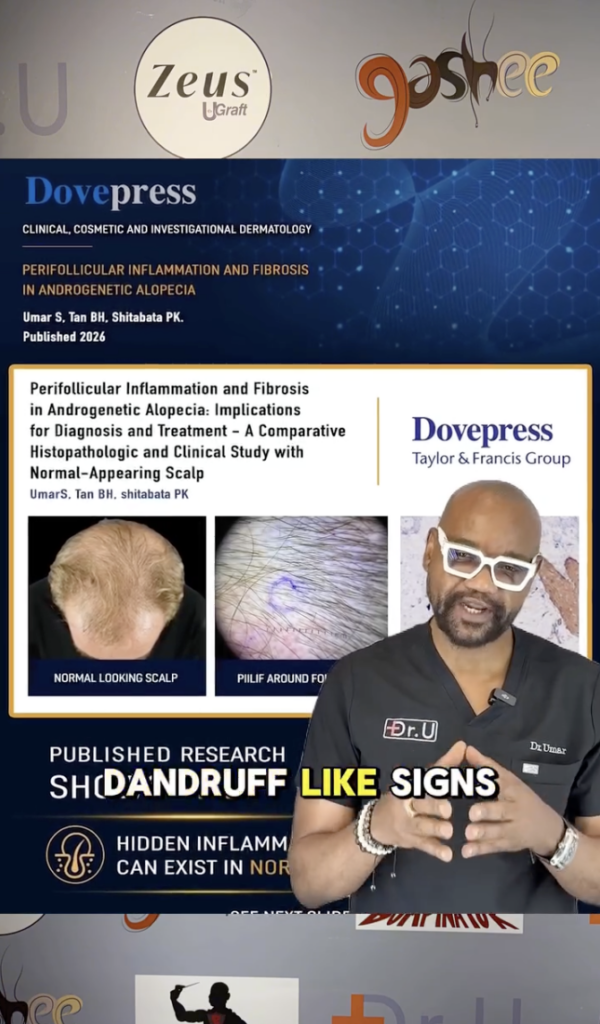 CMS Alt Text: Dr. Sanusi Umar beside a DovePress research graphic about perifollicular inflammation and fibrosis in androgenetic alopecia.