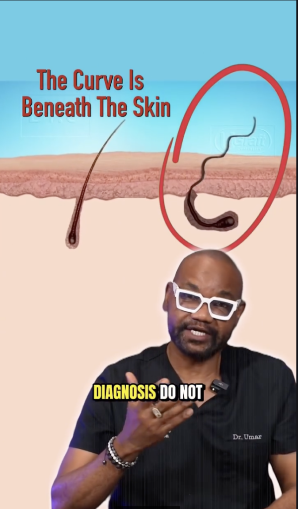 Illustration comparing a straighter hair follicle with a curved follicle beneath the skin, circled in red, with Dr. Sanusi Umar speaking in the foreground.
