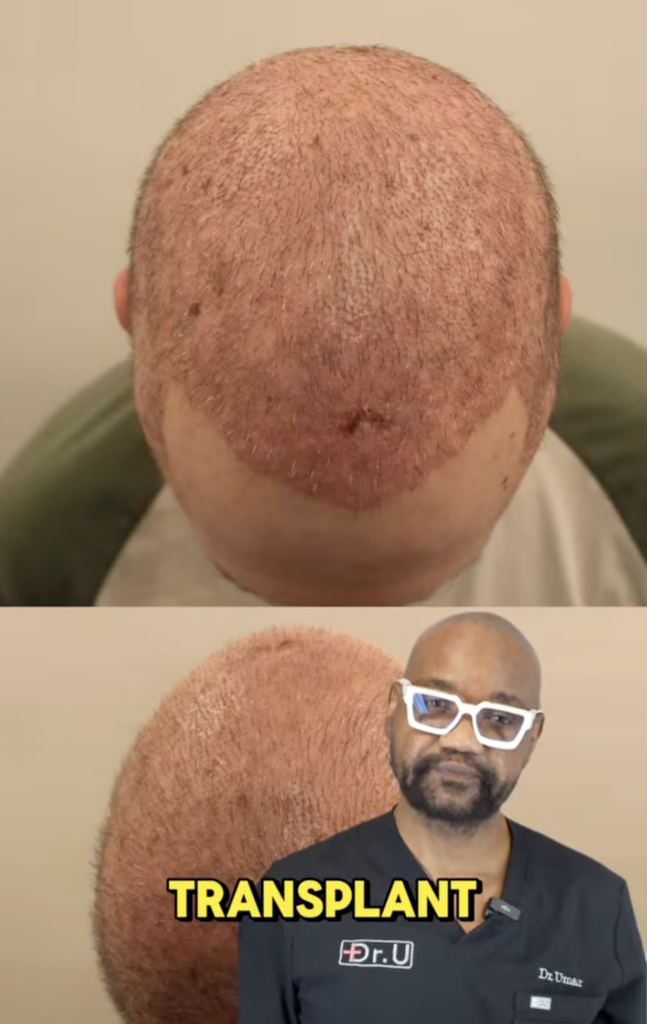 Composite image showing a closely shaved scalp with visible redness and Dr. Sanusi Umar speaking in a video frame labeled transplant.