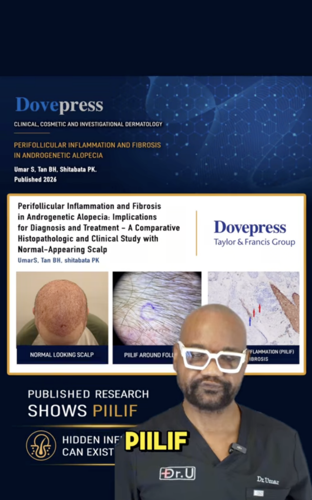 Video graphic showing a Dove Medical Press research article on perifollicular inflammation and fibrosis, scalp images, and Dr. Sanusi Umar.